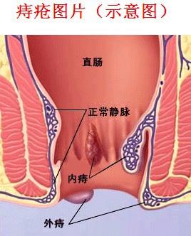 正常肛门图片和痔疮图片 女性痔疮图片